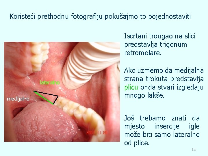 Koristeći prethodnu fotografiju pokušajmo to pojednostaviti Iscrtani trougao na slici predstavlja trigonum retromolare. lateralno