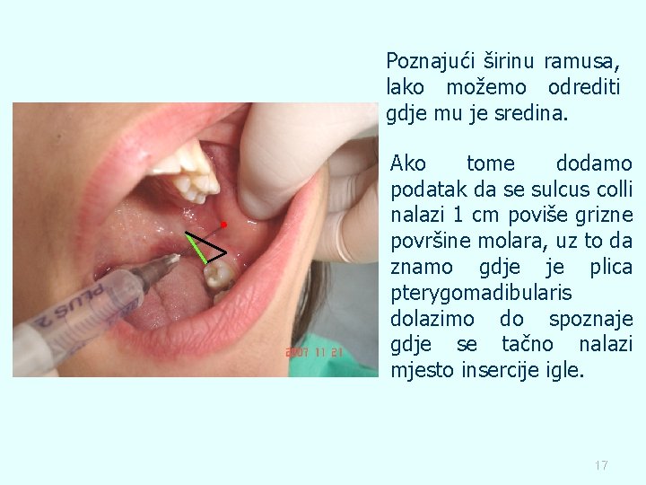 Poznajući širinu ramusa, lako možemo odrediti gdje mu je sredina. Ako tome dodamo podatak