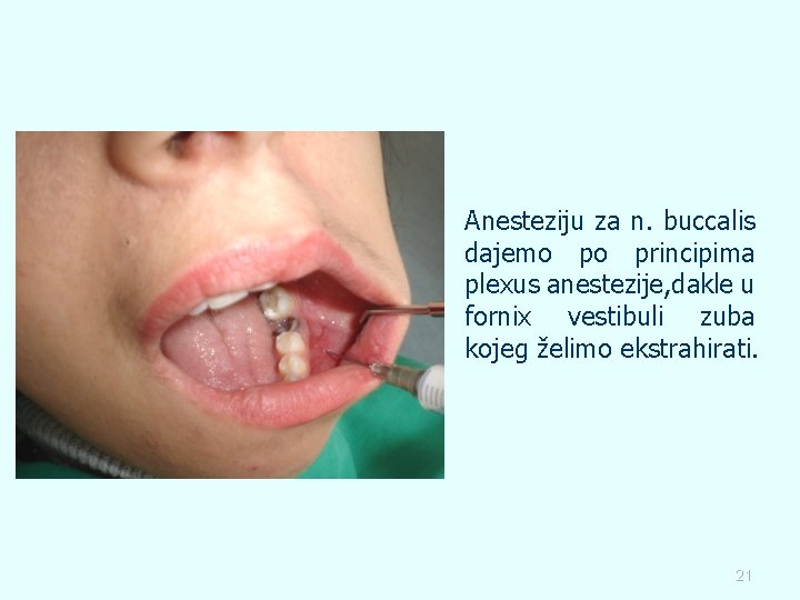 Anesteziju za n. buccalis dajemo po principima plexus anestezije, dakle u fornix vestibuli zuba