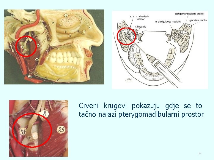 Crveni krugovi pokazuju gdje se to tačno nalazi pterygomadibularni prostor 6 
