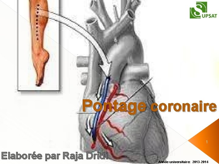 Pontage coronaire 1 Elaborée par Raja Dridi Année universitaire: 2013 -2014 