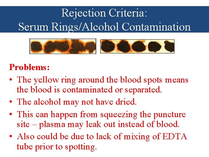 Rejection Criteria: Serum Rings/Alcohol Contamination Problems: • The yellow ring around the blood spots