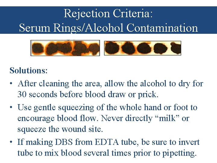 Rejection Criteria: Serum Rings/Alcohol Contamination Solutions: • After cleaning the area, allow the alcohol