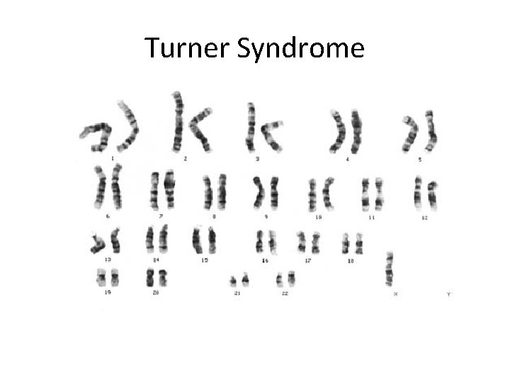 Turner Syndrome 