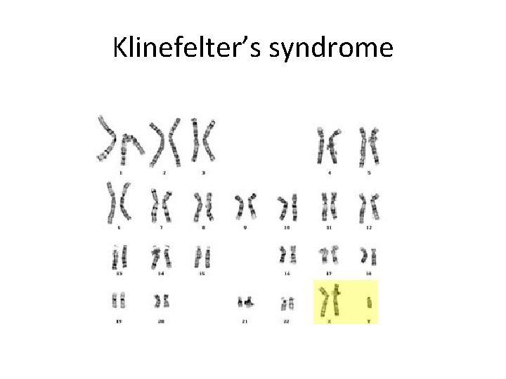 Klinefelter’s syndrome 