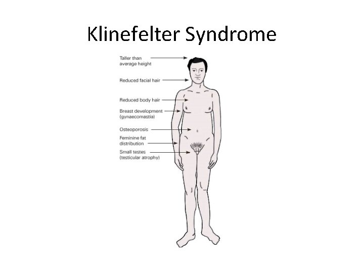 Klinefelter Syndrome 