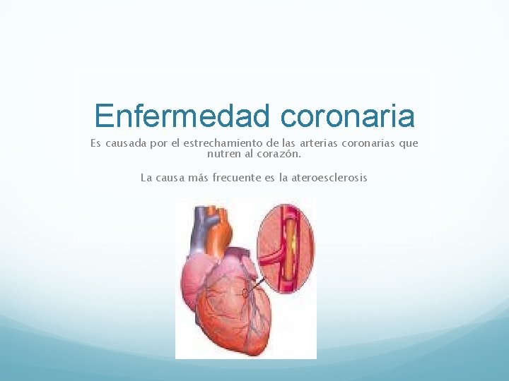 Enfermedad coronaria Es causada por el estrechamiento de las arterias coronarias que nutren al