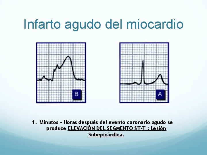 Infarto agudo del miocardio 1. Minutos – Horas después del evento coronario agudo se