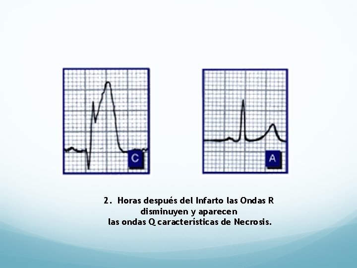 2. Horas después del Infarto las Ondas R disminuyen y aparecen las ondas Q