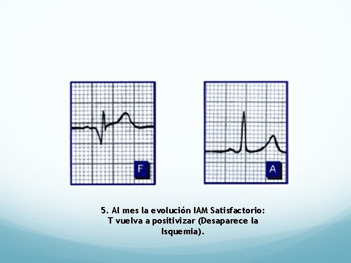 5. Al mes la evolución IAM Satisfactorio: T vuelva a positivizar (Desaparece la Isquemia).