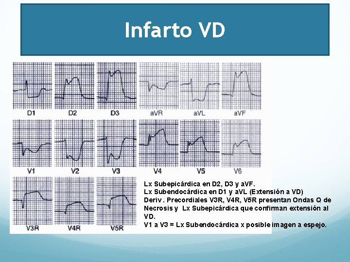 Infarto VD Lx Subepicárdica en D 2, D 3 y a. VF. Lx Subendocárdica
