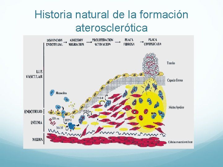 Historia natural de la formación aterosclerótica 