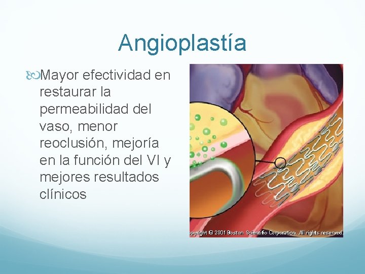 Angioplastía Mayor efectividad en restaurar la permeabilidad del vaso, menor reoclusión, mejoría en la