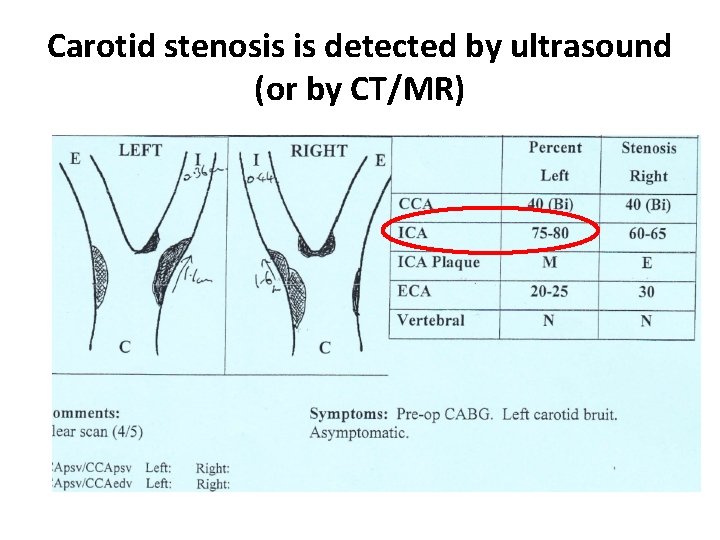 Carotid stenosis is detected by ultrasound (or by CT/MR) 