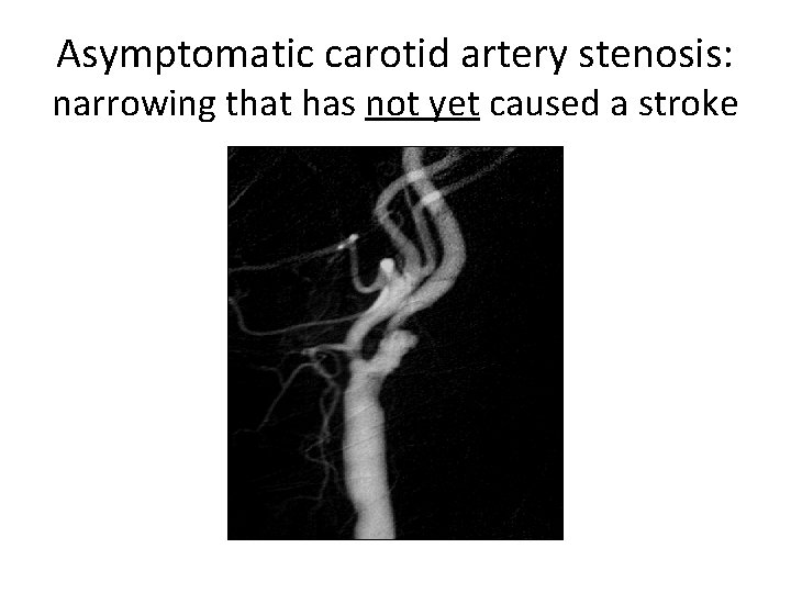 Asymptomatic carotid artery stenosis: narrowing that has not yet caused a stroke 