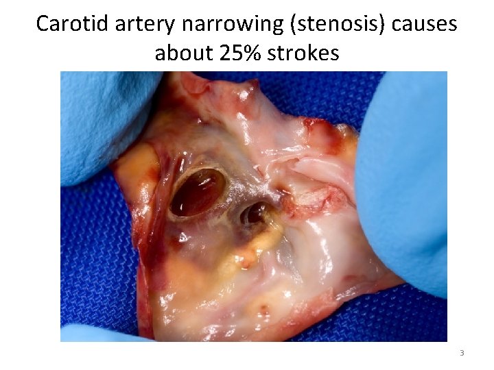 Carotid artery narrowing (stenosis) causes about 25% strokes 3 