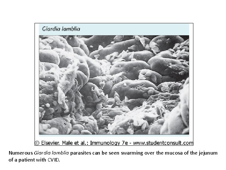 Numerous Giardia lamblia parasites can be seen swarming over the mucosa of the jejunum