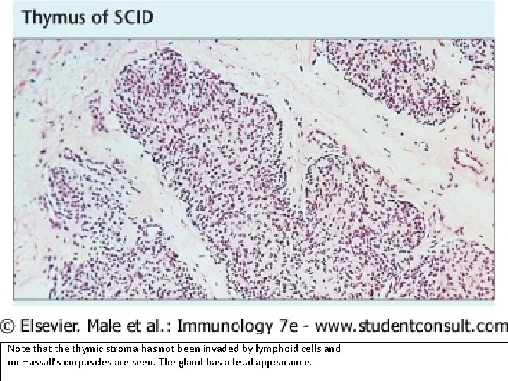  Note that the thymic stroma has not been invaded by lymphoid cells and