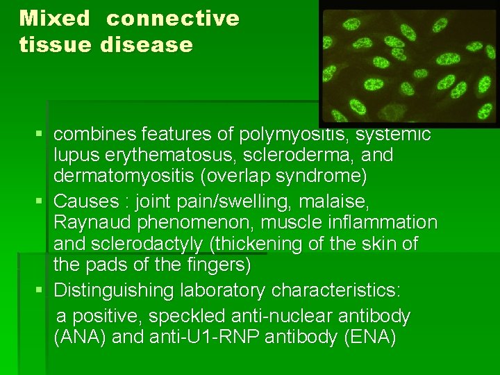 Mixed connective tissue disease § combines features of polymyositis, systemic lupus erythematosus, scleroderma, and