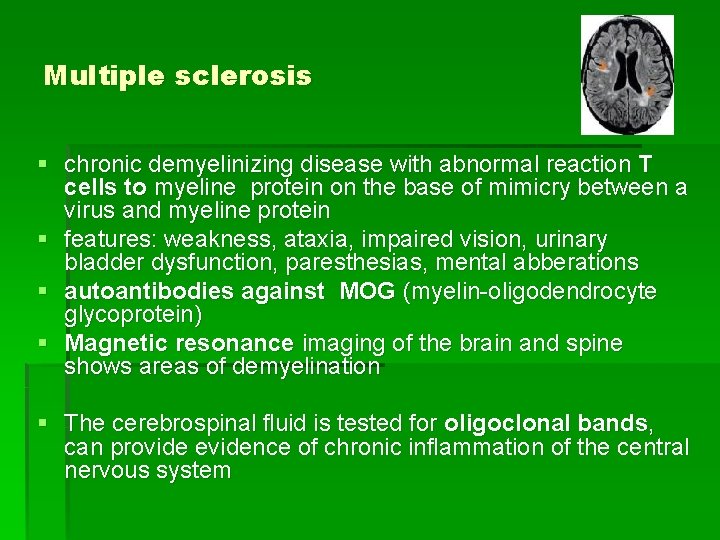 Multiple sclerosis § chronic demyelinizing disease with abnormal reaction T cells to myeline protein