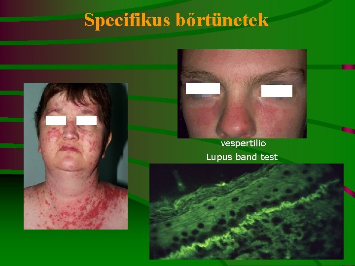 Specifikus bőrtünetek vespertilio Lupus band test 