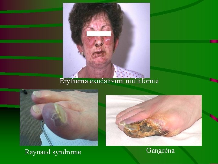 Erythema exudativum multiforme Raynaud syndrome Gangréna 