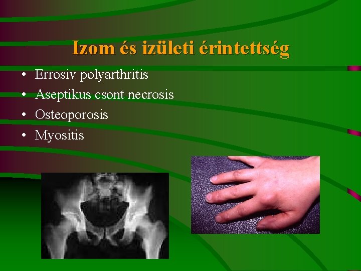 Izom és izületi érintettség • • Errosiv polyarthritis Aseptikus csont necrosis Osteoporosis Myositis 