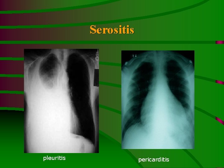 Serositis pleuritis pericarditis 