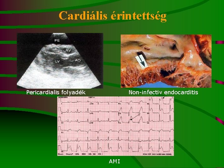 Cardiális érintettség Pericardialis folyadék Non-infectiv endocarditis AMI 