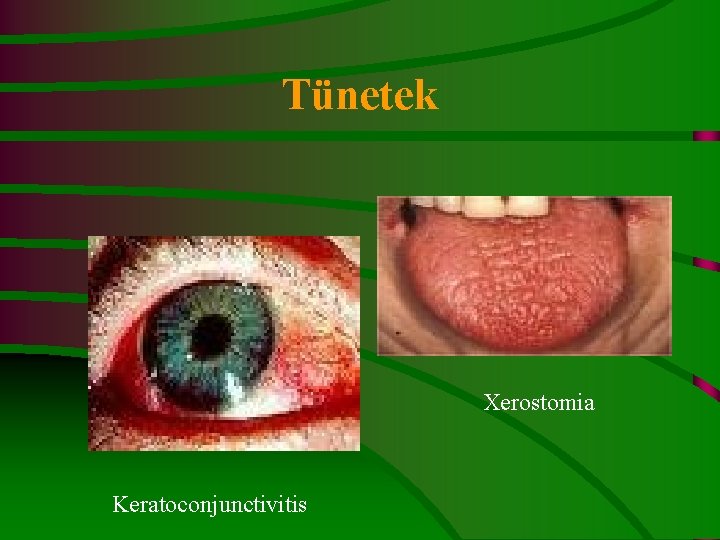 Tünetek Xerostomia Keratoconjunctivitis 