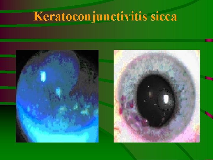 Keratoconjunctivitis sicca 