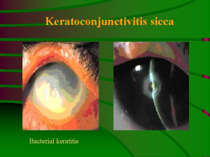 Keratoconjunctivitis sicca Bacterial keratitis 