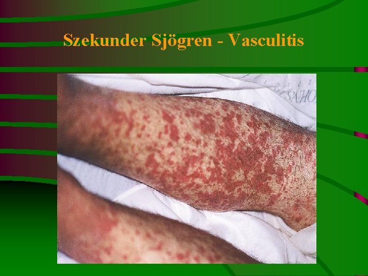 Szekunder Sjögren - Vasculitis 