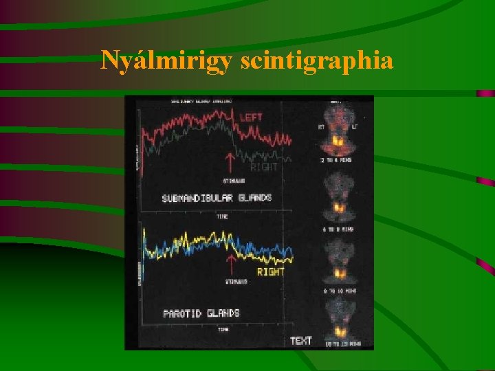 Nyálmirigy scintigraphia 