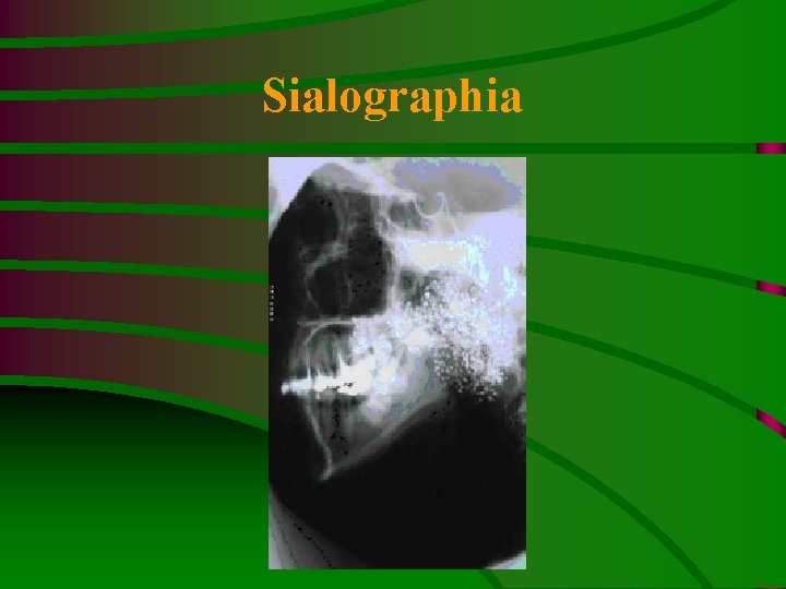 Sialographia 