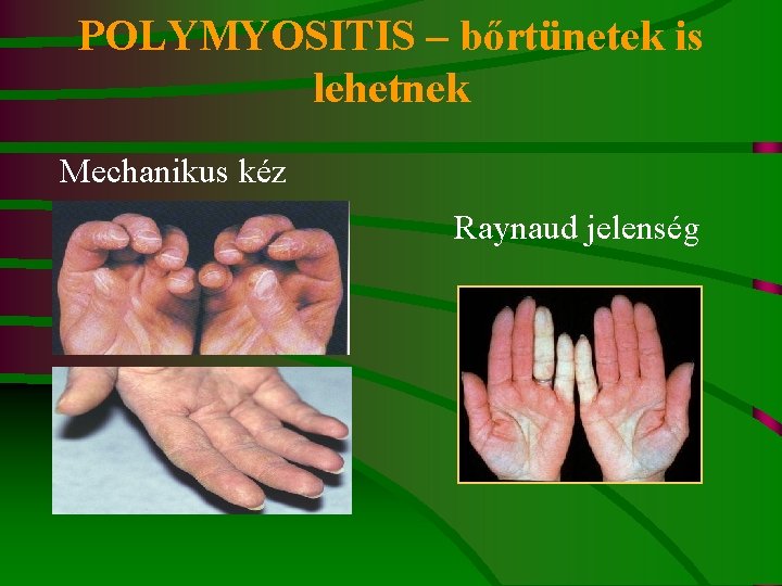 POLYMYOSITIS – bőrtünetek is lehetnek Mechanikus kéz Raynaud jelenség 