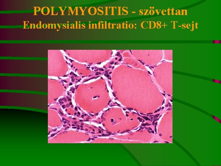 POLYMYOSITIS - szövettan Endomysialis infiltratio: CD 8+ T-sejt 