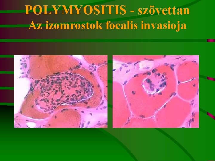 POLYMYOSITIS - szövettan Az izomrostok focalis invasioja 