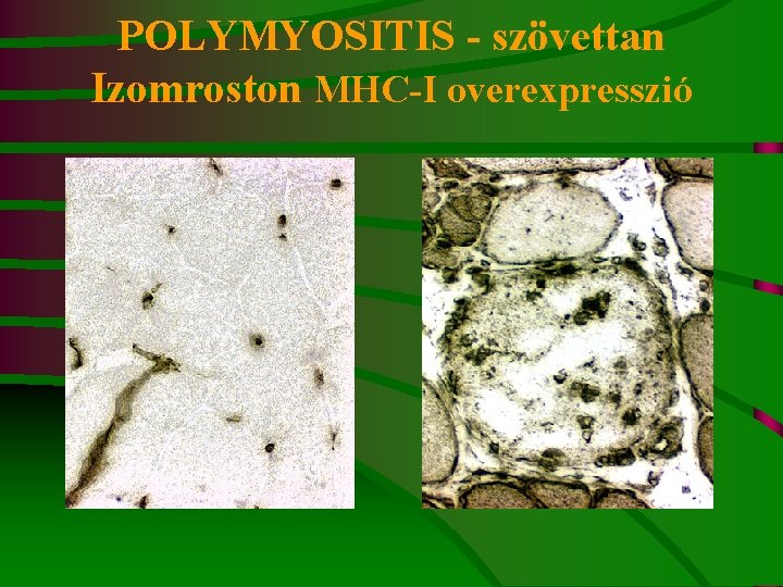 POLYMYOSITIS - szövettan Izomroston MHC-I overexpresszió 