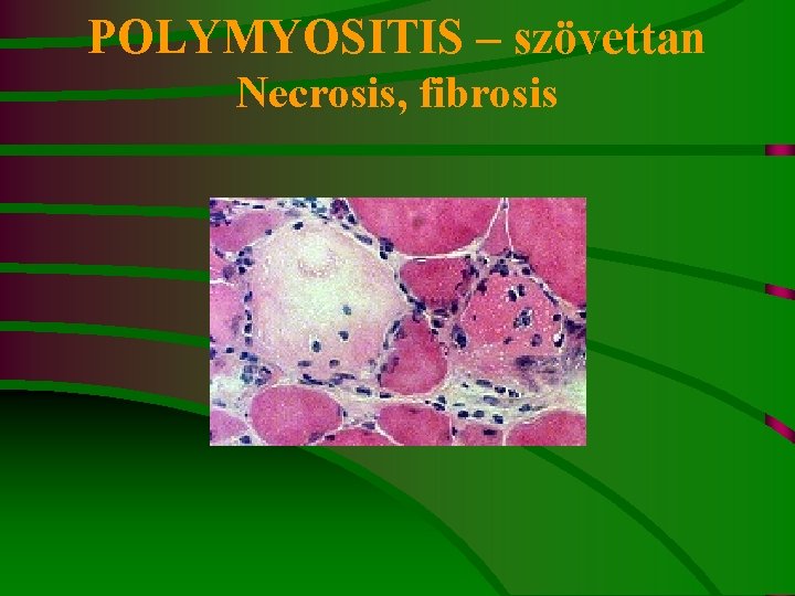 POLYMYOSITIS – szövettan Necrosis, fibrosis 