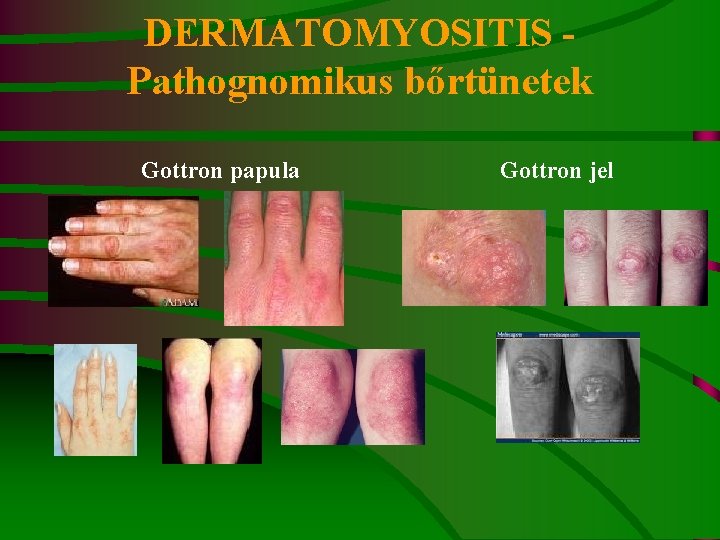 A kötőszövet dermatomyositis szisztémás betegségei - korhatartalanul.hu