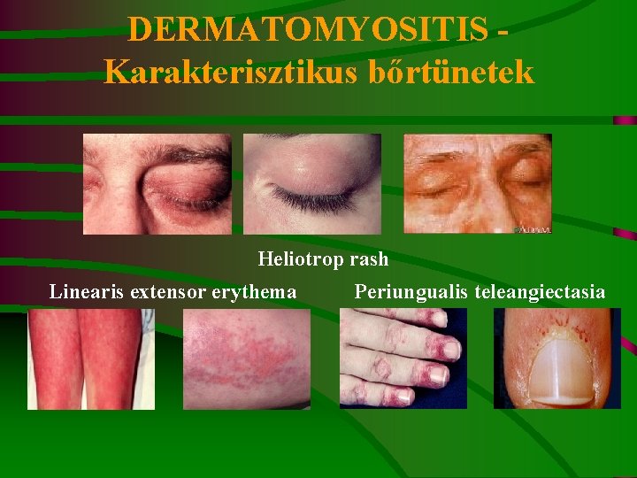 DERMATOMYOSITIS - Karakterisztikus bőrtünetek Heliotrop rash Linearis extensor erythema Periungualis teleangiectasia 