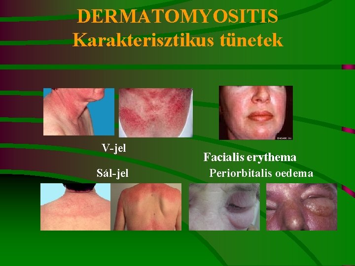 DERMATOMYOSITIS Karakterisztikus tünetek V-jel Sál-jel Facialis erythema Periorbitalis oedema 