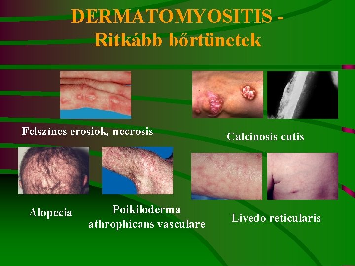 DERMATOMYOSITIS - Ritkább bőrtünetek Felszínes erosiok, necrosis Alopecia Poikiloderma athrophicans vasculare Calcinosis cutis Livedo