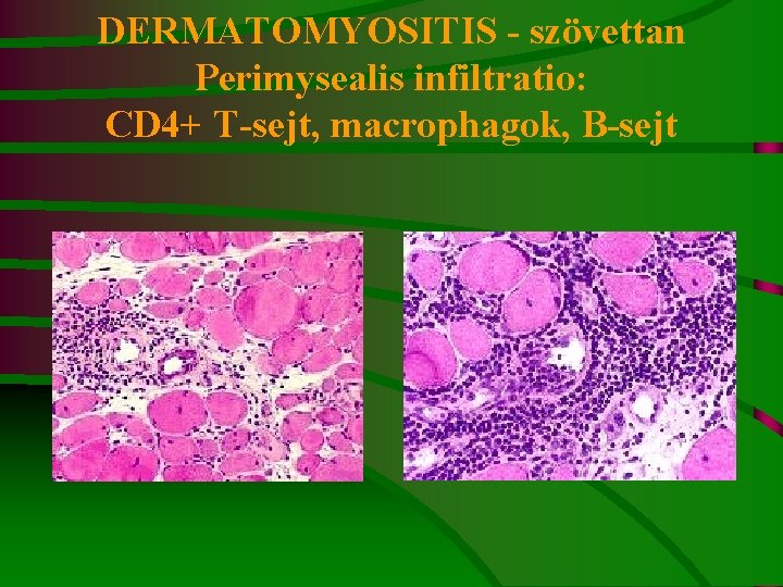 DERMATOMYOSITIS - szövettan Perimysealis infiltratio: CD 4+ T-sejt, macrophagok, B-sejt 