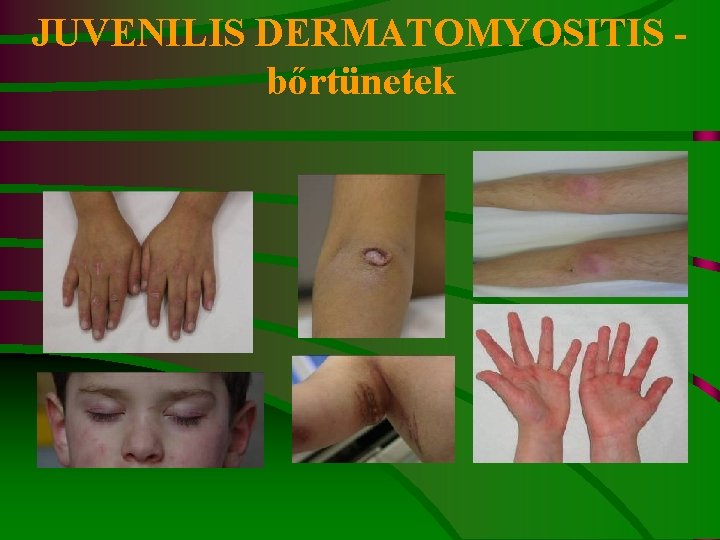 JUVENILIS DERMATOMYOSITIS - bőrtünetek 