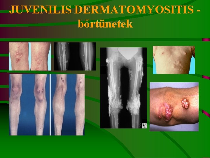 JUVENILIS DERMATOMYOSITIS - bőrtünetek 