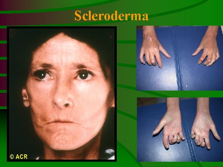 Scleroderma 