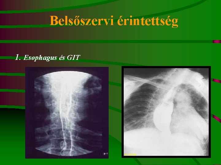 Belsőszervi érintettség 1. Esophagus és GIT 