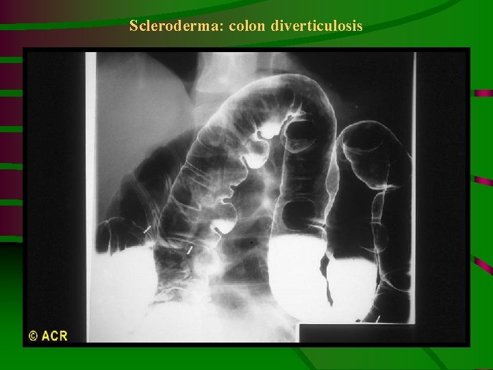 Scleroderma: colon diverticulosis 